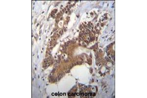 PCYT1A Antibody immunohistochemistry analysis in formalin fixed and paraffin embedded human colon carcinoma followed by peroxidase conjugation of the secondary antibody and DAB staining. (PCYT1A anticorps  (N-Term))