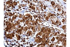 IHC-P Image MMP2 antibody detects MMP2 protein at cytosol and nucleus on human breast carcinoma by immunohistochemical analysis.