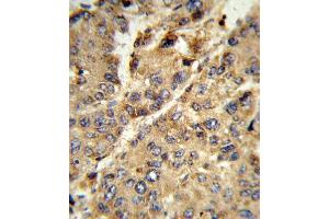 Formalin-fixed and paraffin-embedded human hepatocarcinoma reacted with XDH Antibody (N-term), which was peroxidase-conjugated to the secondary antibody, followed by DAB staining.