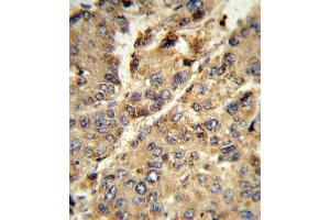Formalin-fixed and paraffin-embedded human hepatocarcinoma reacted with XDH Antibody (N-term), which was peroxidase-conjugated to the secondary antibody, followed by DAB staining. (XDH anticorps  (N-Term))