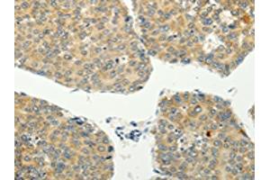 The image on the left is immunohistochemistry of paraffin-embedded Human liver cancer tissue using ABIN7128020(SPIN4 Antibody) at dilution 1/20, on the right is treated with fusion protein. (SPIN4 anticorps)