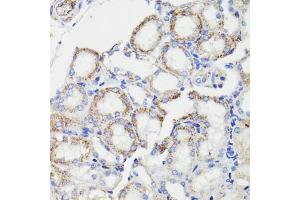Immunohistochemistry of paraffin-embedded human breast cancer using PDCD10 antibody (ABIN7269540) at dilution of 1:100 (40x lens). (PDCD10 anticorps  (AA 1-212))