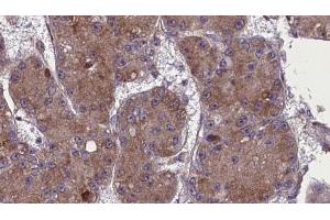 ABIN6272765 at 1/100 staining Human liver cancer tissue by IHC-P.