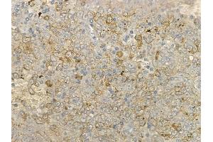 ABIN6266251 and ABIN6277406 at 1/100 staining human melanoma by IHC-P. (MMP25 anticorps  (Internal Region))