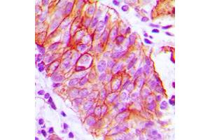 Immunohistochemical analysis of CD147 staining in human prostate cancer formalin fixed paraffin embedded tissue section. (CD147 anticorps  (C-Term))