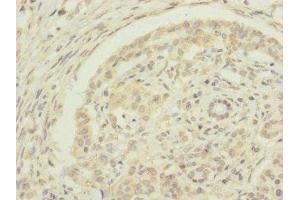 Immunohistochemistry of paraffin-embedded human pancreatic cancer using ABIN7151440 at dilution of 1:100