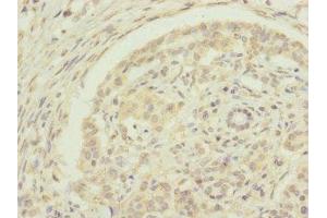 Immunohistochemistry of paraffin-embedded human pancreatic cancer using ABIN7151440 at dilution of 1:100 (EDIL3 anticorps  (AA 60-300))