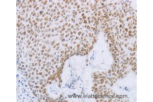 Immunohistochemistry of Human esophagus cancer using MCM2 Polyclonal Antibody at dilution of 1:50 (MCM2 anticorps)