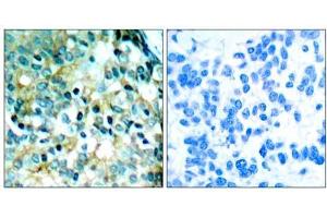 Immunohistochemical analysis of paraffin- embedded human breast carcinoma tissue using Src (phospho- Tyr418) antibody (E011091). (Src anticorps  (pTyr418))