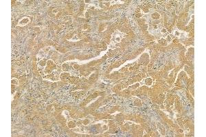 ABIN6261954 and ABIN6276625 at 1/100 staining human lung adenocarcinoma by IHC-P.