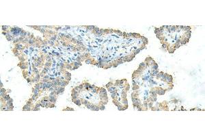 Immunohistochemistry of paraffin-embedded Human thyroid cancer tissue using FCGRT Polyclonal Antibody at dilution of 1:45(x200) (FcRn anticorps)