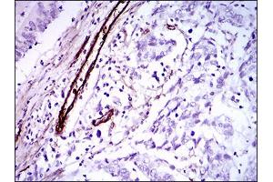 Immunohistochemical analysis of paraffin-embedded colon cancer tissues using GSC mouse mAb with DAB staining.