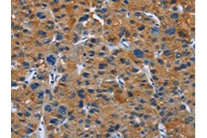 The image on the left is immunohistochemistry of paraffin-embedded Human liver cancer tissue using ABIN7130272(MSH5 Antibody) at dilution 1/30, on the right is treated with fusion protein. (MSH5 anticorps)