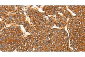 Immunohistochemistry of paraffin-embedded Human liver cancer tissue using SFRP1 Polyclonal Antibody at dilution 1:80 (SFRP1 anticorps)