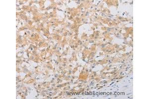 Immunohistochemistry of Human thyroid cancer using PDE4D Polyclonal Antibody at dilution of 1:20 (PDE4D anticorps)