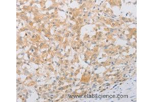 Immunohistochemistry of Human thyroid cancer using PDE4D Polyclonal Antibody at dilution of 1:20