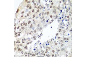 Immunohistochemistry of paraffin-embedded human lung cancer using PTTG1 antibody (ABIN5974823) at dilution of 1/100 (40x lens). (PTTG1 anticorps)