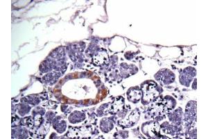 IHC-P Image Immunohistochemical analysis of human salivary gland cancer, using CAD, antibody at 1:100 dilution.