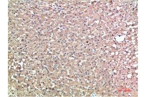 Immunohistochemical analysis of paraffin-embedded Human Liver Carcinoma Tissue using TTR Mouse mAb diluted at 1:200.