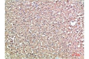 Immunohistochemical analysis of paraffin-embedded Human Liver Carcinoma Tissue using TTR Mouse mAb diluted at 1:200. (TTR anticorps)