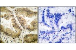 Immunohistochemistry analysis of paraffin-embedded human lung carcinoma tissue, using HDAC7 Antibody. (HDAC7 anticorps  (AA 901-950))