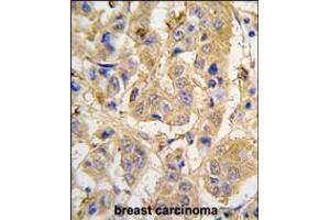 Formalin-fixed and paraffin-embedded human breast carcinoma tissue reacted with MIPEP antibody , which was peroxidase-conjugated to the secondary antibody, followed by DAB staining. (MIPEP anticorps  (AA 307-336))