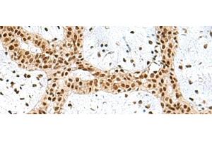 Immunohistochemistry of paraffin-embedded Human breast cancer tissue using PRPF40A Polyclonal Antibody at dilution of 1:60(x200) (PRPF40A anticorps)
