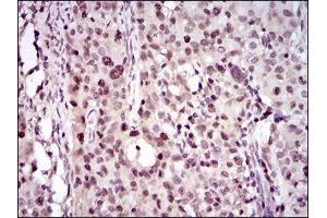 Immunohistochemical analysis of paraffin-embedded cervical cancer tissues using PCNA mouse mAb with DAB staining.
