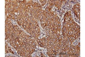 Immunoperoxidase of monoclonal antibody to MVP on formalin-fixed paraffin-embedded human lung, adenosquamous cell carcinoma.