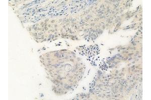 ABIN6259919 and ABIN6269342 at 1/100 staining human cervical carcinoma by IHC-P. (PRKAA1 anticorps  (C-Term))