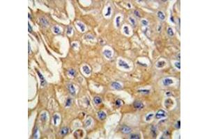 Immunohistochemistry analysis in human lung carcinoma tissue (Formalin-fixed, Paraffin-embedded) using RIPK3 / RIP3  Antibody , followed by peroxidase-conjugated secondary antibody and DAB staining. (RIPK3 anticorps  (Middle Region))