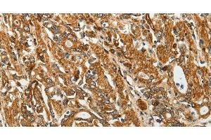 Immunohistochemistry of paraffin-embedded Human gastic cancer using RPLP0 Polyclonal Antibody at dilution of 1:40 (RPLP0 anticorps)