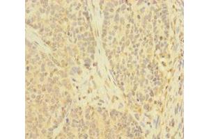 Immunohistochemistry of paraffin-embedded human ovarian cancer using ABIN7173908 at dilution of 1:100 (TNFAIP6 anticorps  (AA 18-277))
