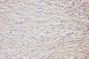 Anti-GFAP Picoband antibody,  IHC(P): Human meningioma Tissue