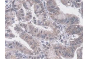 Detection of PTPRF in Human Liver cancer Tissue using Polyclonal Antibody to Protein Tyrosine Phosphatase Receptor Type F (PTPRF)