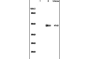 Formalin-fixed and paraffin embedded human colon carcinoma labeled with Anti VIP Receptor 1/VAPC1 Polyclonal Antibody, Unconjugated (ABIN872880) at 1:200 followed by conjugation to the secondary antibody and DAB staining