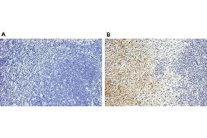 Staining of endogenous human Periostin in human breast cancer tissues (paraffin sections) by using Periostin, mAb (Stiny-1) . (Periostin anticorps  (full length))