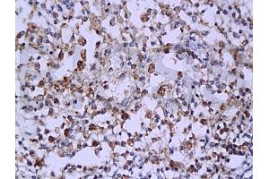 Formalin-fixed and paraffin embedded: human endometrium carcinoma labeled with Anti-Caspase-6 Polyclonal Antibody (ABIN725525), Unconjugated 1:200 followed by conjugation to the secondary antibody and DAB staining (Caspase 6 anticorps  (AA 151-250))