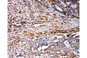 Anti-VRL1 antibody, IHC(P) IHC(P): Human Mammary Cancer Tissue