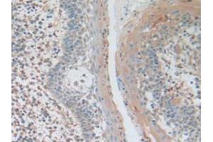 IHC-P analysis of Human Skin Cancer Tissue, with DAB staining. (AKT3 anticorps  (AA 46-338))