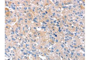 The image on the left is immunohistochemistry of paraffin-embedded Human liver cancer tissue using ABIN7130903(RNF214 Antibody) at dilution 1/20, on the right is treated with fusion protein. (RNF214 anticorps)