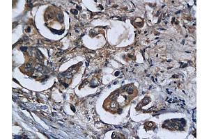 Formalin-fixed and paraffin embedded human colorectal cancer labeled with Anti Legumain Polyclonal Antibody, Unconjugated (ABIN750958) followed by conjugation to the secondary antibody and DAB staining