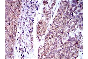 Immunohistochemical analysis of paraffin-embedded bladder cancer tissues using IL2RA mouse mAb with DAB staining.