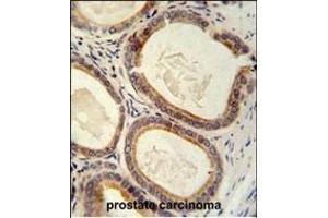 TR antibody (C-term) (ABIN652176 and ABIN2840578) immunohistochemistry analysis in formalin fixed and paraffin embedded human prostate carcinoma followed by peroxidase conjugation of the secondary antibody and DAB staining. (TRAM2 anticorps  (C-Term))
