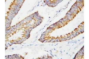 IHC-P: BCAT2 antibody testing of human colon cancer tissue