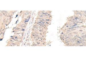 Immunohistochemistry of paraffin-embedded Human lung cancer tissue using OLA1 Polyclonal Antibody at dilution of 1:45(x200) (OLA1 anticorps)