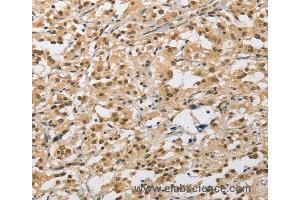 Immunohistochemistry of Human liver cancer using AMZ2 Polyclonal Antibody at dilution of 1:40 (AMZ2 anticorps)