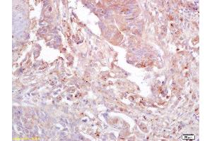 Formalin-fixed and paraffin embedded human lung carcinoma labeled with Anti-GnRHR Polyclonal Antibody, Unconjugated  at 1:200 followed by conjugation to the secondary antibody and DAB staining