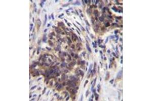 Immunohistochemistry analysis in formalin fixed and paraffin embedded human lung carcinoma reacted with Alpha-glucosidase Antibody (N-term) followed by peroxidase conjugation of the secondary antibody and DAB staining. (AGLU anticorps  (N-Term))