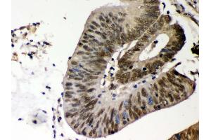 Anti- CSNK1A1 Picoband antibody,IHC(P) IHC(P): Human Intestinal Cancer Tissue